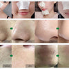 BREYLEE Tea Tree Blackhead Remover